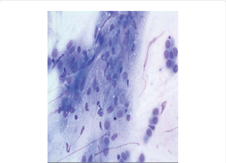 Diff Quik Stained Slides Show Histiocyte-like Cells - Google Slides (761x551), Png Download