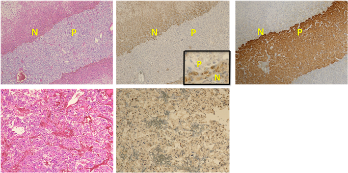 An Nf1 Pheochromocytoma, Lower - Neurofibromin 1 (903x352), Png Download