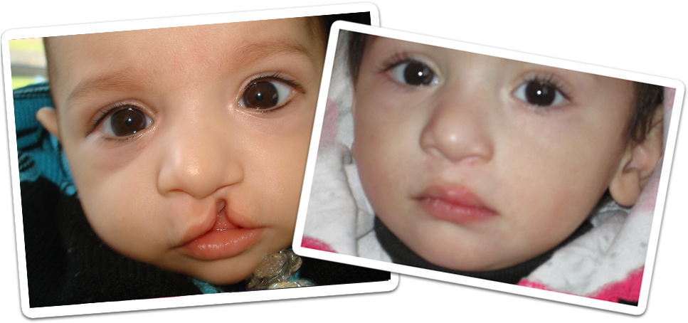 According To The Pclpa Officials One In Every 530 Children - Cleft Lip And Cleft Palate (978x494), Png Download