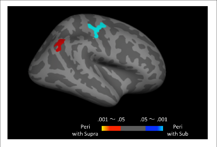 Peri Second Trials Intermixed With Supra Second Trials - Brain (740x503), Png Download