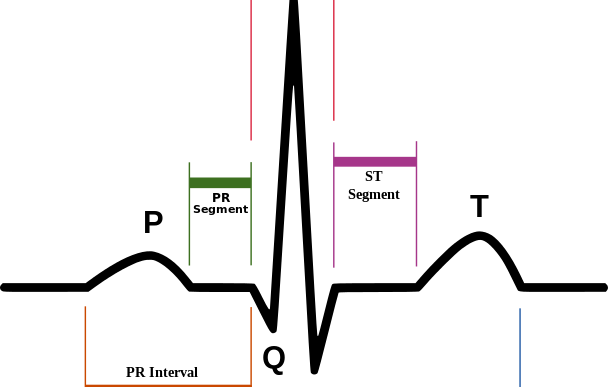 Ecg And Holter Monitoring - Spikes And Dips Ekg (608x387), Png Download