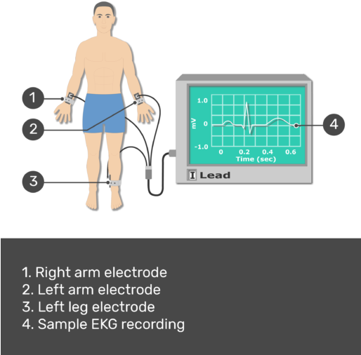 Test Yourself Image For The Placement Of Ecg Electrodes - Ecg Placement Arm (513x550), Png Download