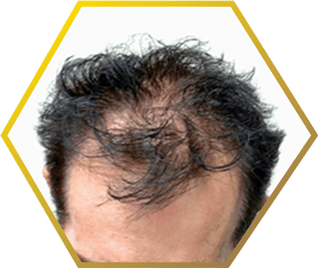 Male Pattern Baldness - Hair Loss (450x380), Png Download