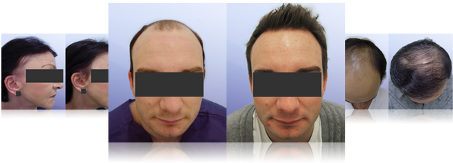 Male Hair Transplant Surgery Before And After Gallery - Melbourne (660x238), Png Download