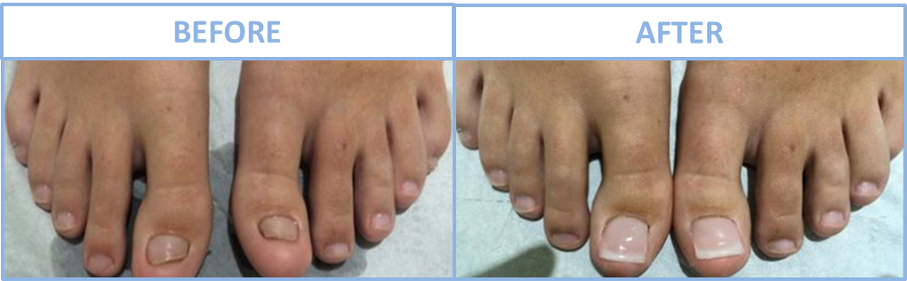 Nail Reconstruction - Fingernail Reconstruction (1020x316), Png Download