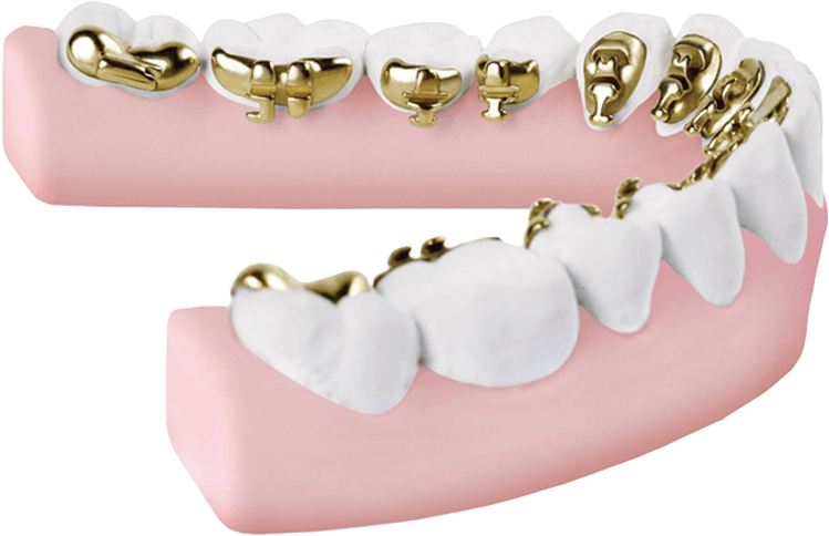 Lingual Braces (817x637), Png Download