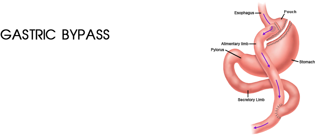 Roux En Y Gastric Bypass (1050x500), Png Download