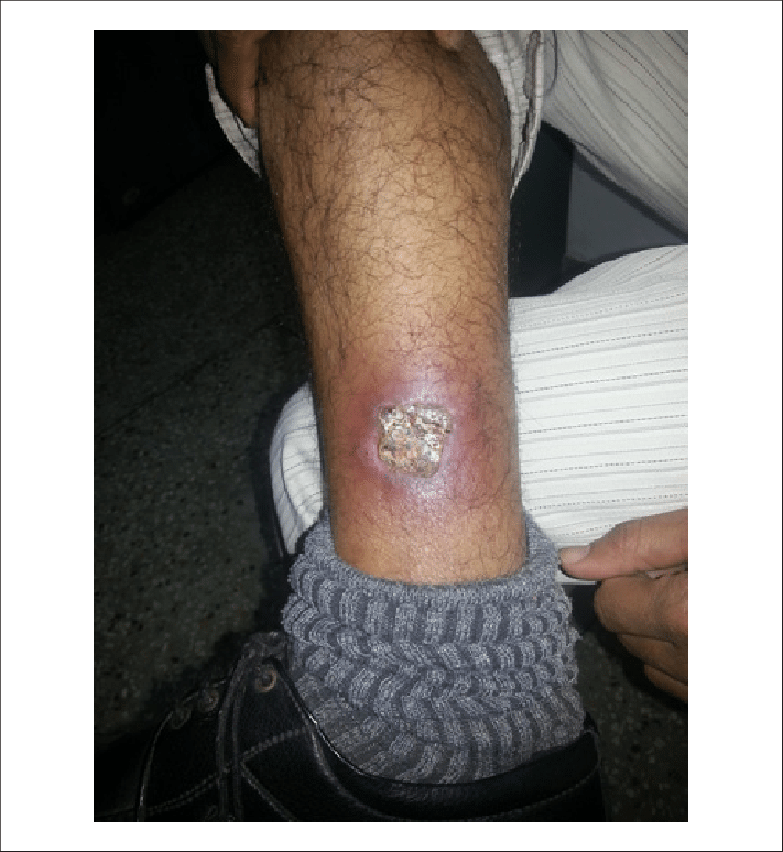 A Neglected Case Of Third Degree Muffler Induced Burn - Burn After Two Months (711x774), Png Download