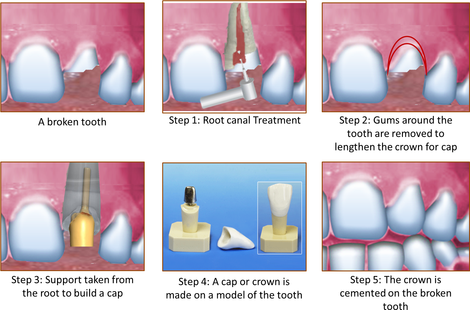 So Are You Afraid Of Having Your Tooth Pulled Out Do - Crown On Broken Tooth (1584x1076), Png Download