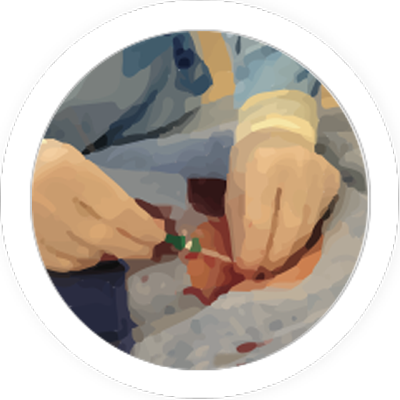Interventional Radiology Chitosan Bandage Procedure - Bandage (400x400), Png Download