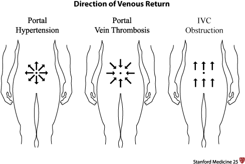 Abdominal Venous Patterns - Portal Hypertension Vs Ivc Obstruction (500x330), Png Download