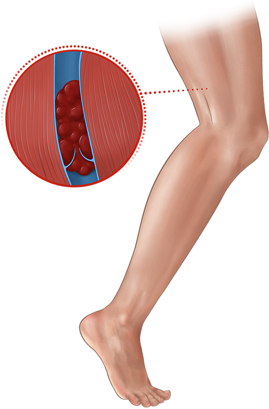 Deep Vein Thrombosis (839x800), Png Download