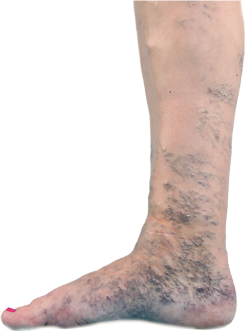 Varicose Veins (576x666), Png Download