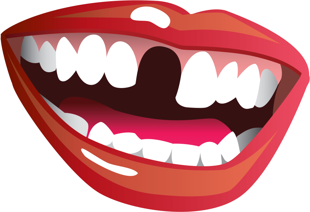 Smile With Missing Tooth (1024x706), Png Download