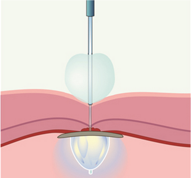 Uv Light And Balloons Can Plug Holes In Your Heart - Heart (1000x750), Png Download