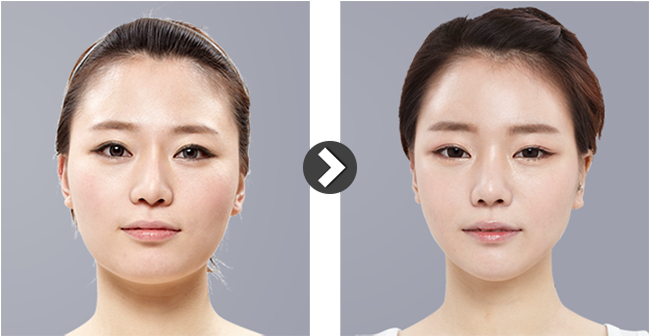 Korean Square Jaw Surgery T Osteotomy Or Dia Osteotomy (825x383), Png ...