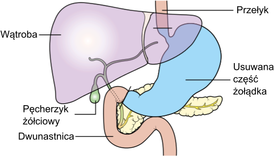 Diagam Showing The Anatomy Before Roux En Y Surgery - Stomach And Pancreas Diagram (558x329), Png Download