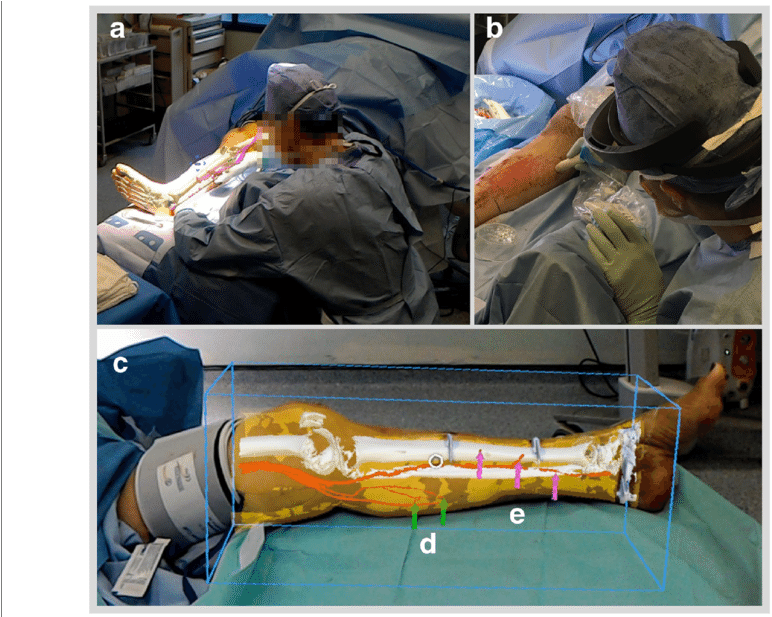 A Case 3 Ar Overlay Of Models As Viewed From Remote (850x616), Png Download