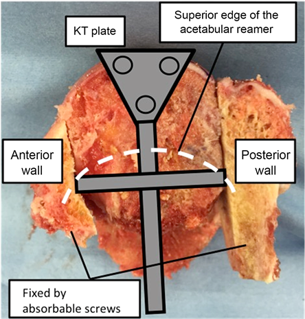 Jet Type Helmet Like Allograft That We Created - Kerboull Plate (903x466), Png Download