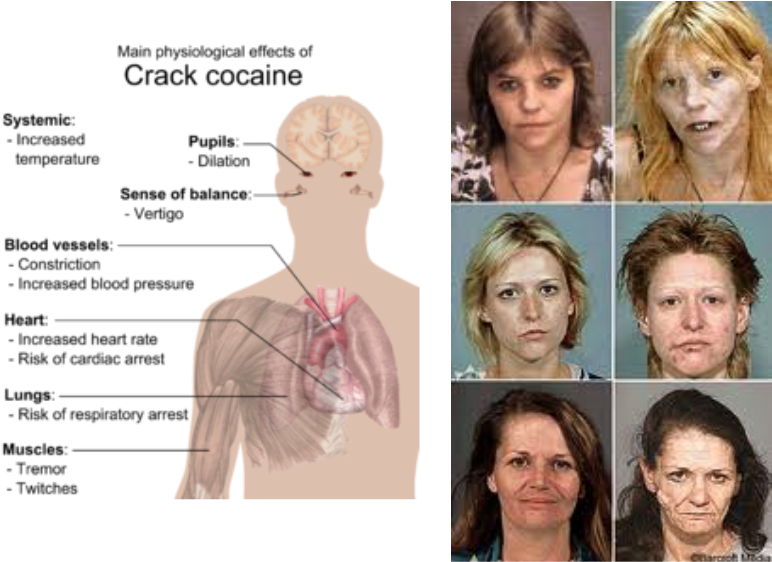 Learn About The Immediate Shortterm And Longterm Cocaine - Crack Does To Your Body (780x563), Png Download
