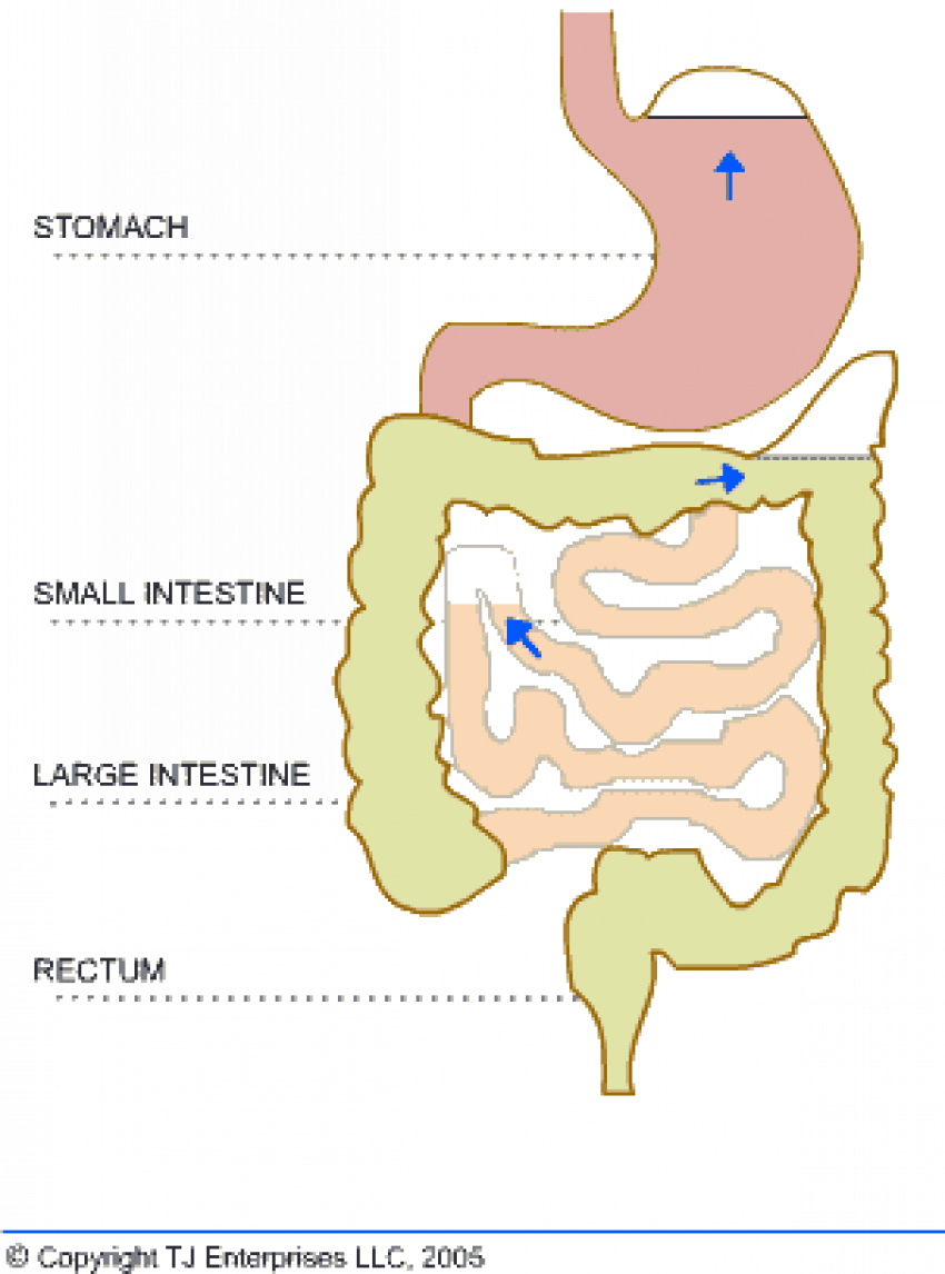 Why Does Baby Wind Cause Pain - Gas Bubble In Stomach (850x1146), Png Download
