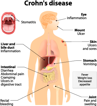 Why Is Capsule Endoscopy Done - Dont Text And Drive (378x398), Png Download