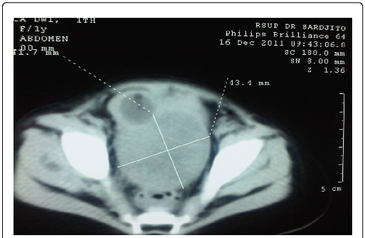 Ct-scan Found Heterogeneous Mass With Solid And Cystic - Urinary Bladder Wall Cyst (513x334), Png Download