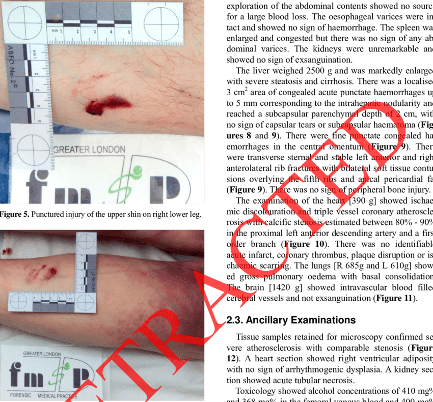 Punctured Injury Of The Lower Calf On Right Lower Leg, - Blood (850x790), Png Download
