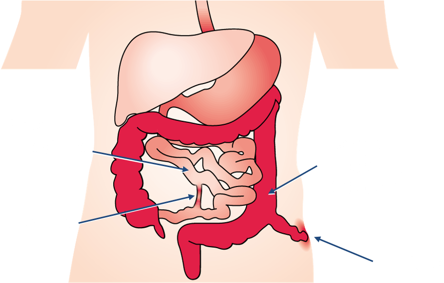 Crohn's Disease Complications - Illustration (955x588), Png Download