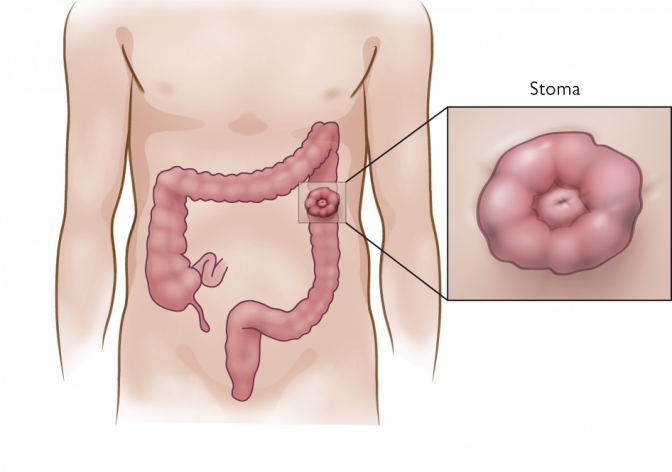 Different Types Of Ostomy Procedures Are Performed - Diagram (672x472), Png Download