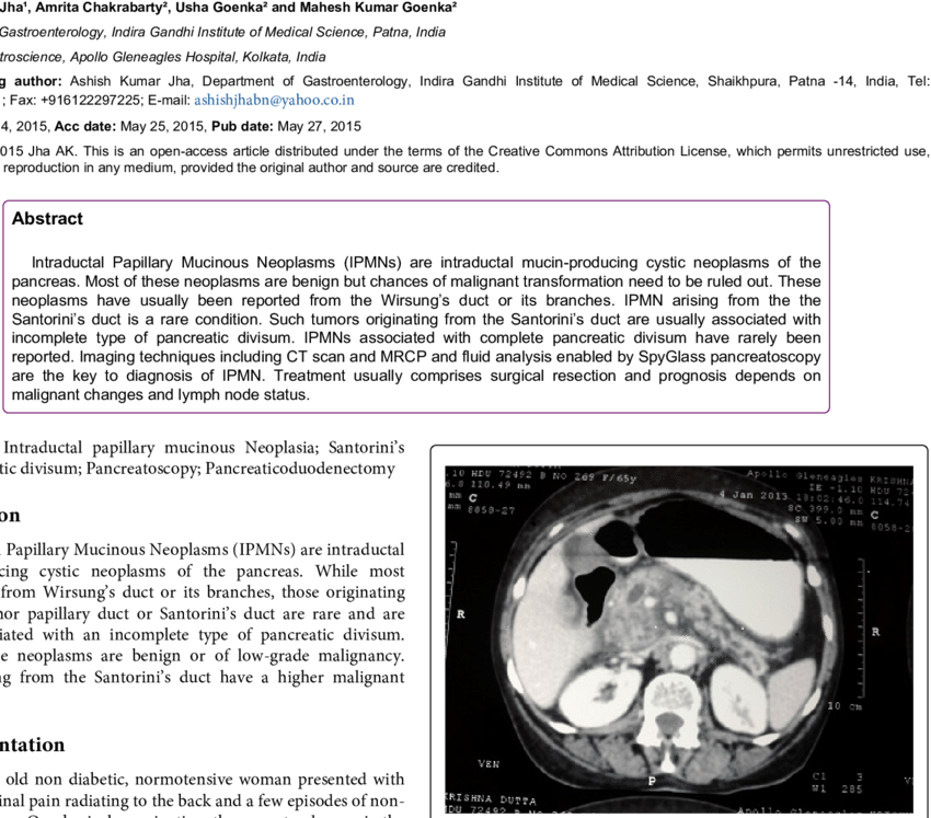 Abdominal Ct-scan Showing A Bulky Head And Uncinate - Skull (850x747), Png Download