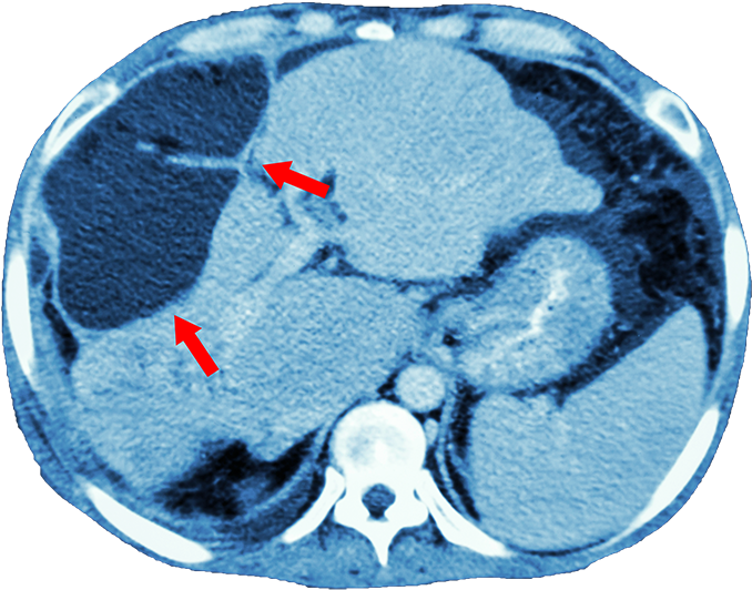 Of The Abdomen And Pelvis) To Look For A Mass In The - Ct Scan Dataset Of Liver Cancer (700x549), Png Download