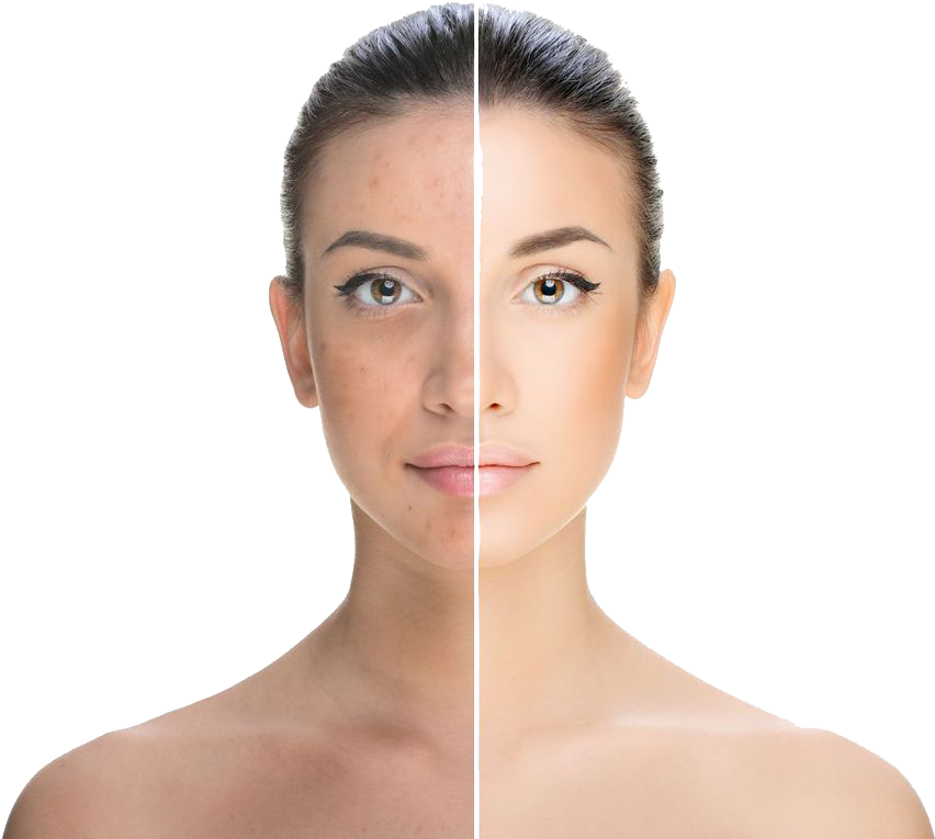 Hsmodelface - Chemical Peel (900x798), Png Download