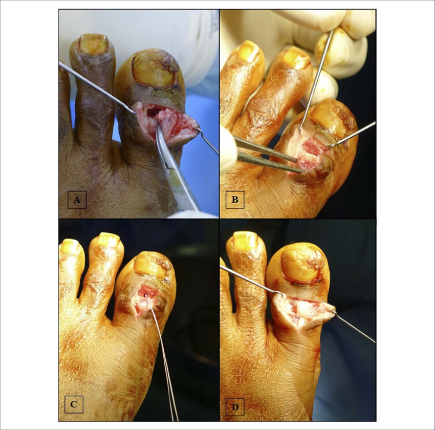 Dorsal T-shaped Incision With The Ip Joint Explored - Twinkie (850x840), Png Download