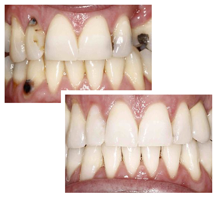 Before And After Full Mouth Reconstruction - Laugh (800x900), Png Download