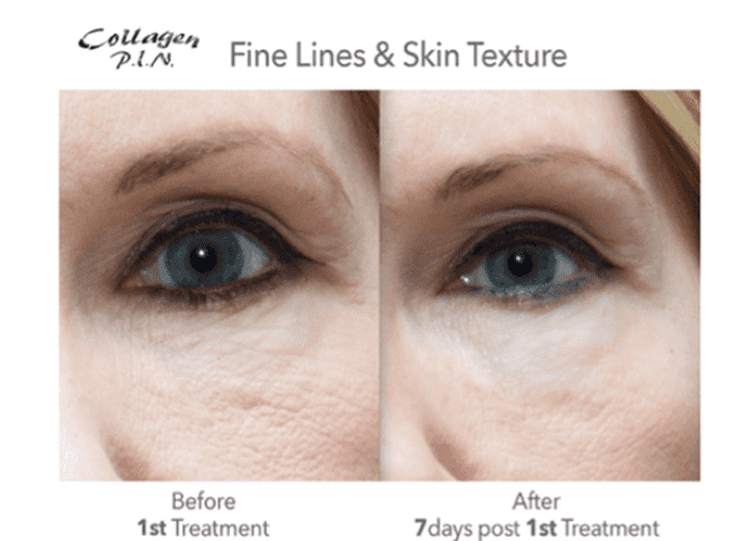 Before And After - Microneedling Fine Lines Before And After (750x742), Png Download