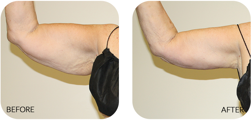 This Surgical Procedure Reduces Sagging Excess Skin - Upper Arms (842x404), Png Download