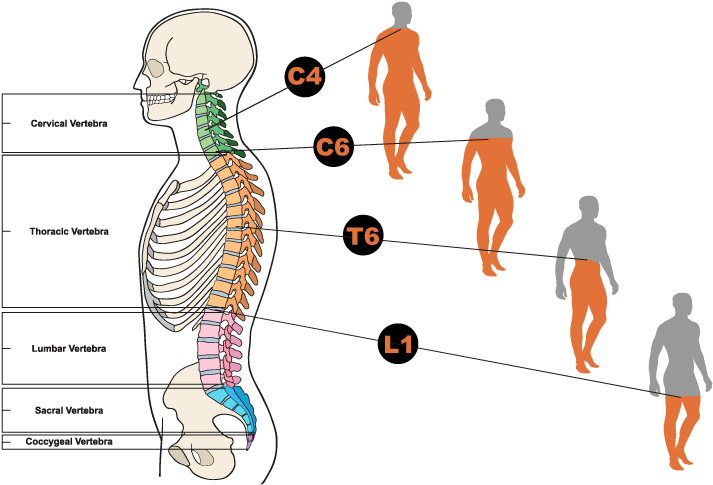 Diagram Showing Different Types Of Spinal Cord Injuries - Illustration (800x500), Png Download