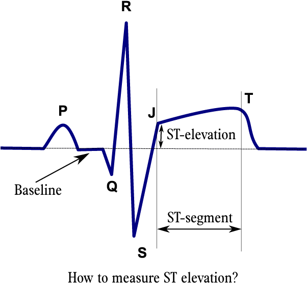 Stelevatie En - Ecg Of Mi Patient (611x614), Png Download