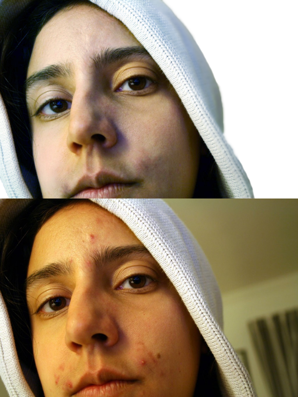 I Will Remove Acne From Your Face - Light Skin With Pimples (1024x1366), Png Download