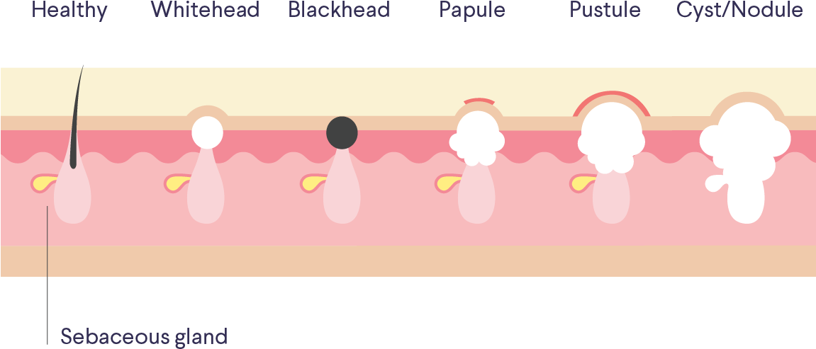 What Is Acne, Anyway First Off, Knowledge Is Power - Diagram (1401x901), Png Download