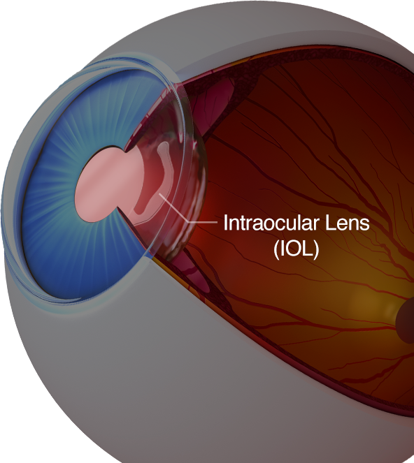 A Multifocal Intraocular Lense Displayed Against A - Iol Refractive Surgery (592x663), Png Download