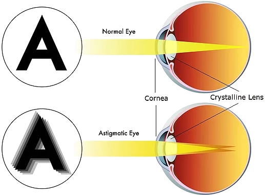 Astigmatism - Normal Eye Vs Astigmatism (846x509), Png Download