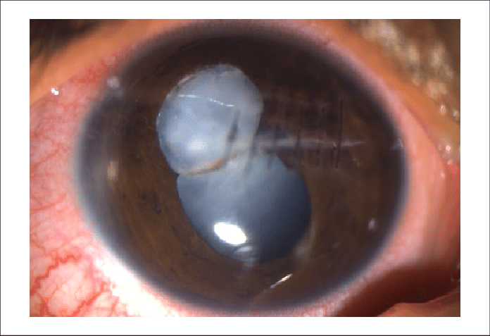 Slit Lamp Photograph Showing Ruptured Anterior Lens - Art (696x477), Png Download
