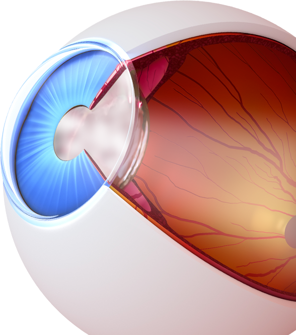 Diagram Of An Eye With Cataracts - Sphere (588x664), Png Download