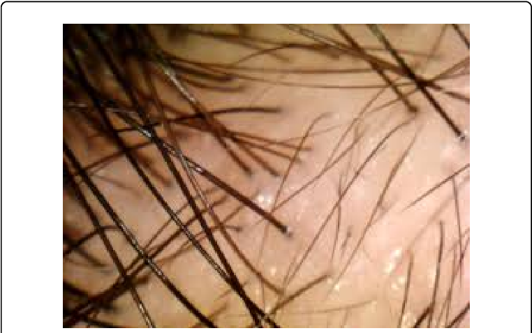 Thin Slow Growing Hair Over Affected Area With Adjacent - Macro Photography (769x480), Png Download