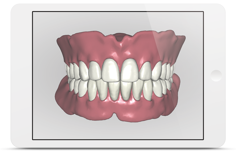 Avadent Ipad - 3d Gebitsprothese (1000x667), Png Download