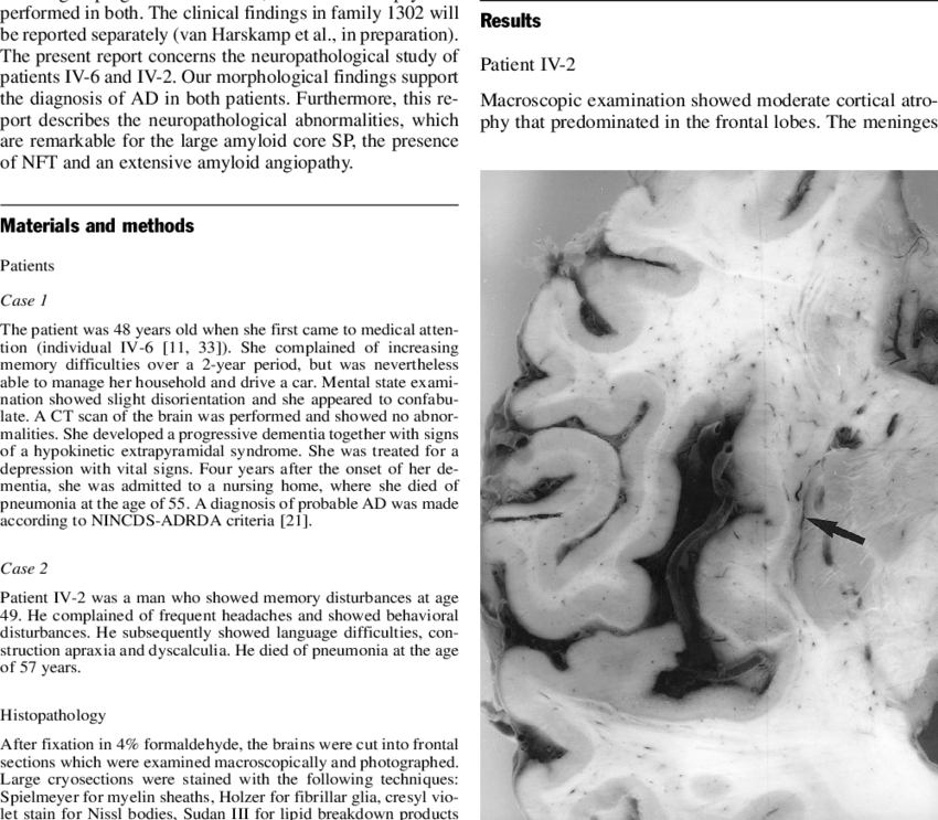 Small Subcortical Hemorrhage In The Right Insular Region - Monochrome (850x743), Png Download