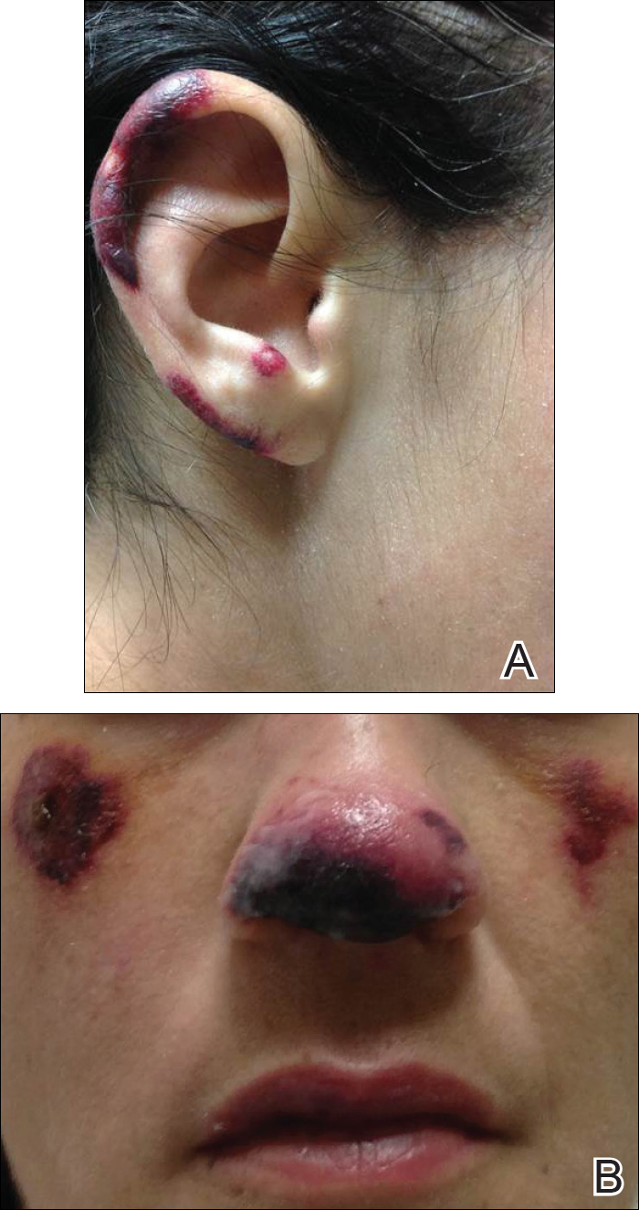 Purpura And Hemorrhagic Bullae Of The Right Ear As - Body Jewelry (700x1325), Png Download