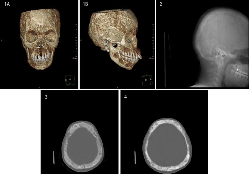 This Is A Frontal 3d Reconstruction View Showing Multiple - Maxillofacial Ct Scan (850x597), Png Download